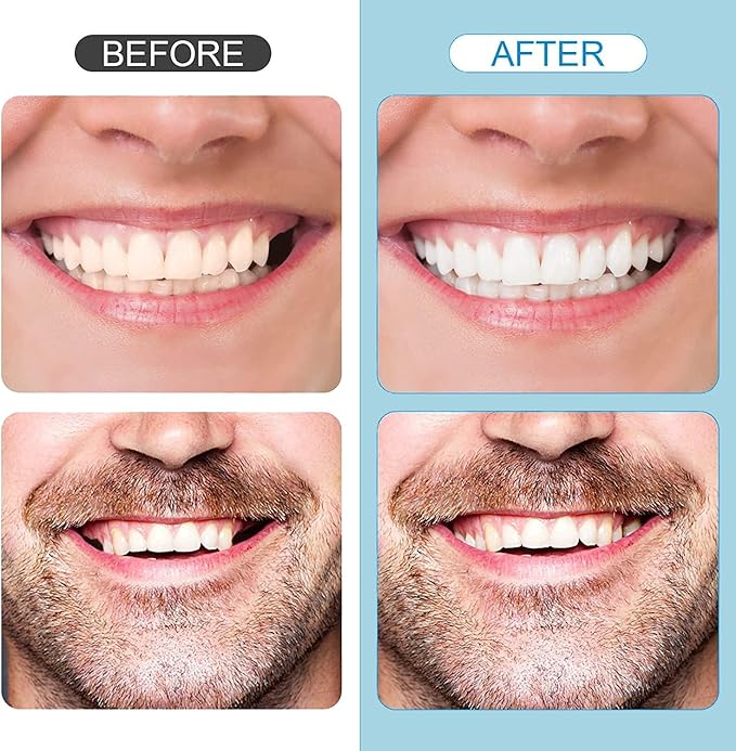 Tooth Repair Kit,Temporary Natural Shade for Filling The Gap, Moldable Thermal Beads Replacement Kit Replace The Missing or Broken Tooth-6PCS-D67