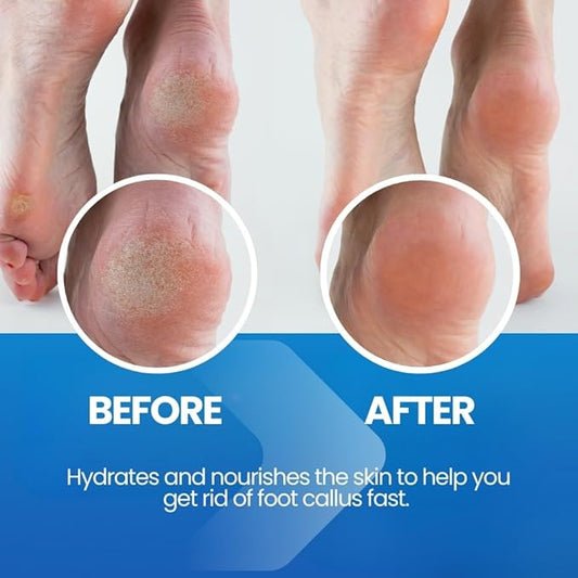 Imperial Feet Callus Softener Spray for Feet Extra Strength – Callus Remover for Feet & Toes, Hard Skin Remover for Dry Cracked Heels, Foot Dead Skin Remover for Pedicure & Foot Care
